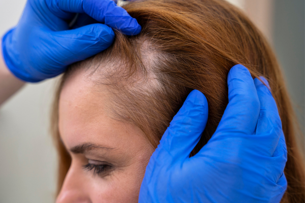 Una donna con capelli diradati viene esaminata da un medico con guanti blu