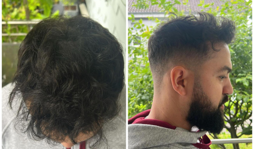 Prima e dopo un trapianto di capelli, con risultati naturali e definiti.