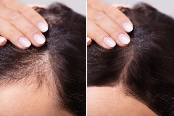 Una donna mostra i suoi capelli prima e dopo la procedura.