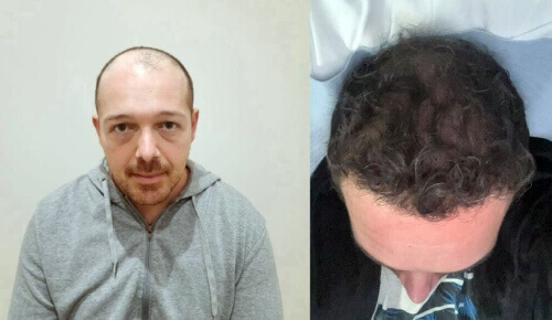Foto prima e dopo trapianto capelli Albania