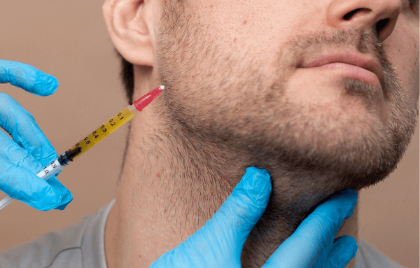 Iniezione PRP sulla barba per stimolare la crescita dei follicoli.