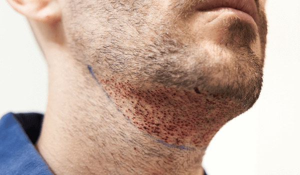 Il collo e il mento di un uomo dopo un trapianto di barba con FUE, con piccoli punti rossi
sulla pelle e una linea blu guida