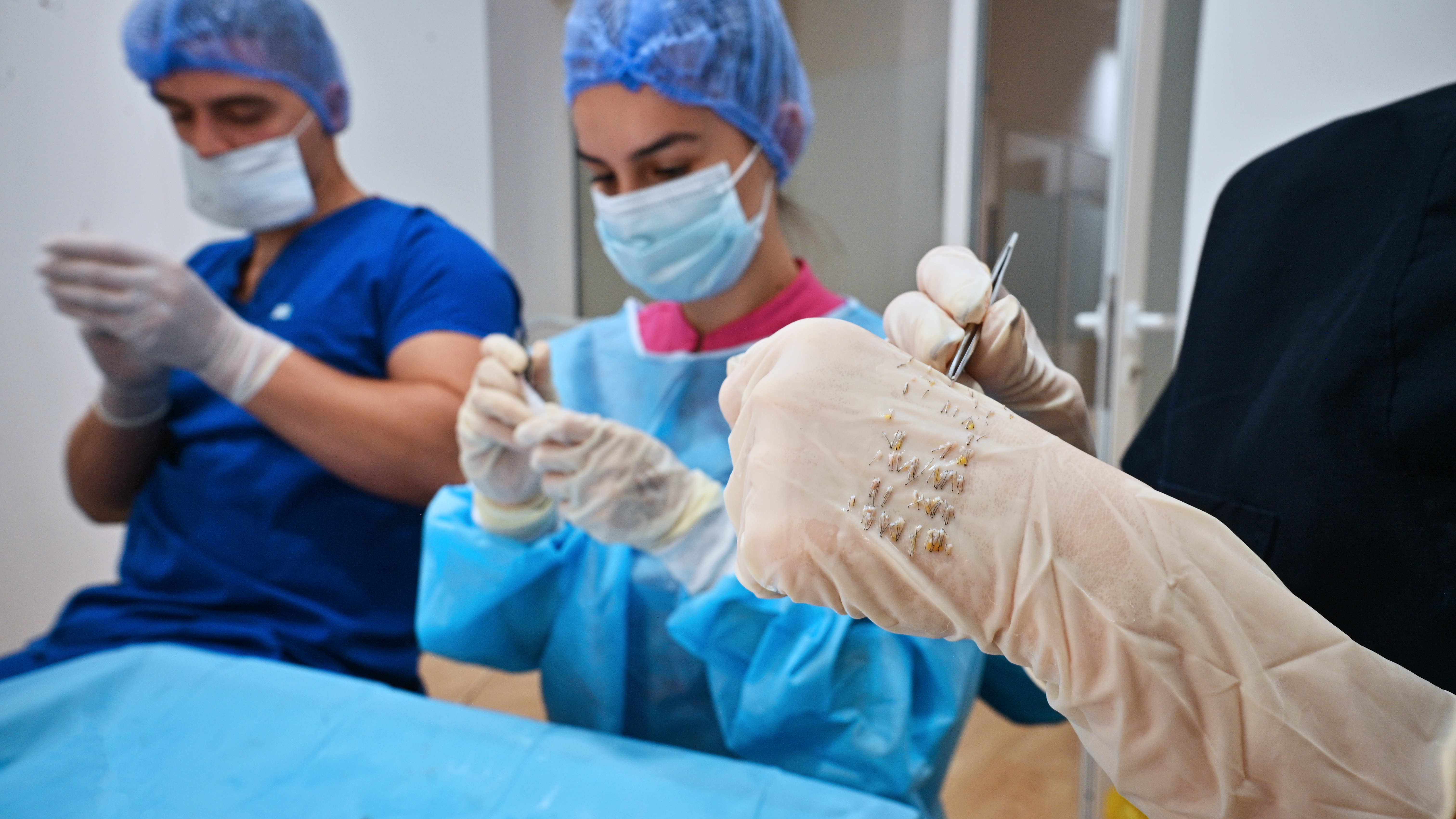 Medici che preparano i follicoli per un trapianto di sopracciglia in clinica