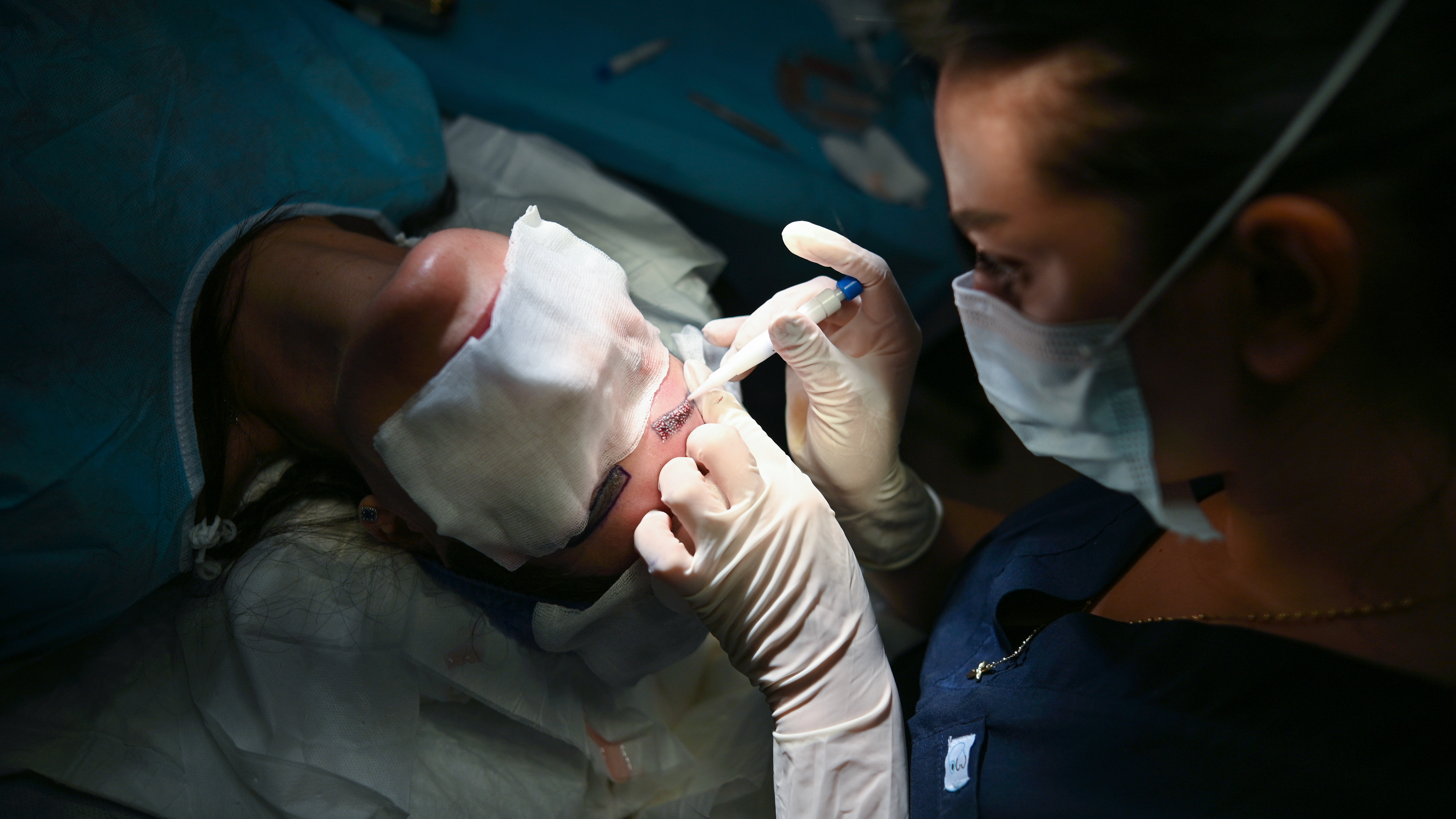 Medico che esegue un trapianto di sopracciglia su una paziente