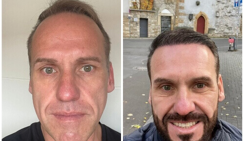 Foto dei risultati prima e dopo il trapianto